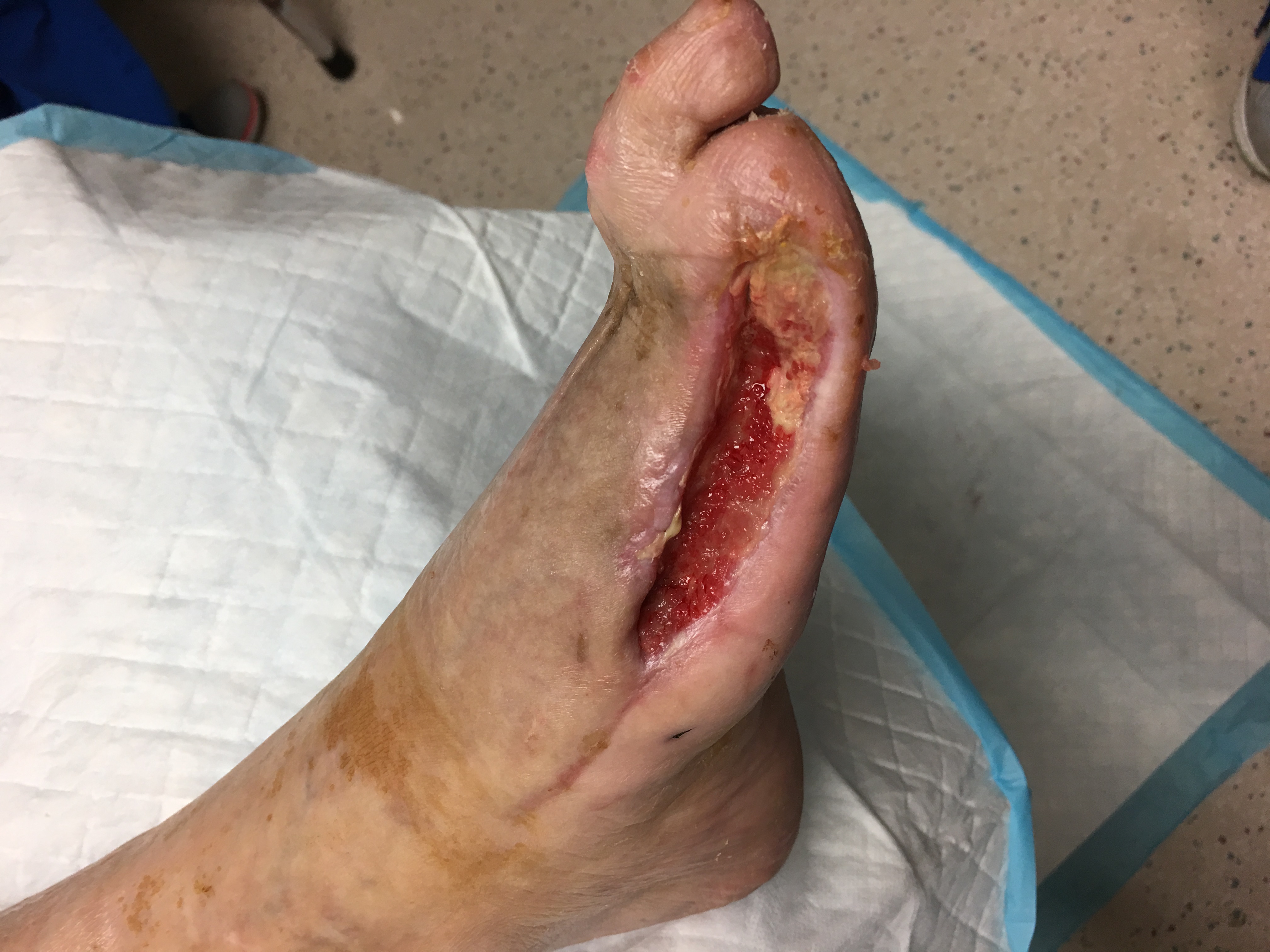 Surgical wound granulation tissue